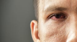 Safety Health And Wellness Eye Infection Eye Strain
