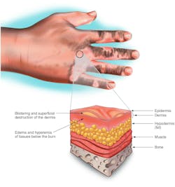 The updated recommendations from OSHA released in November 2024 update personal protective equipment (PPE) guidance to provide electrical professionals working on energized electrical equipment proper protection from electrical arc hazards that could result in second degree burns as shown above. The updated recommendations from OSHA released in November 2024 update personal protective equipment (PPE) guidance to provide electrical professionals working on energized electrical equipment proper protection from electrical arc hazards that could result in second degree burns as shown above.